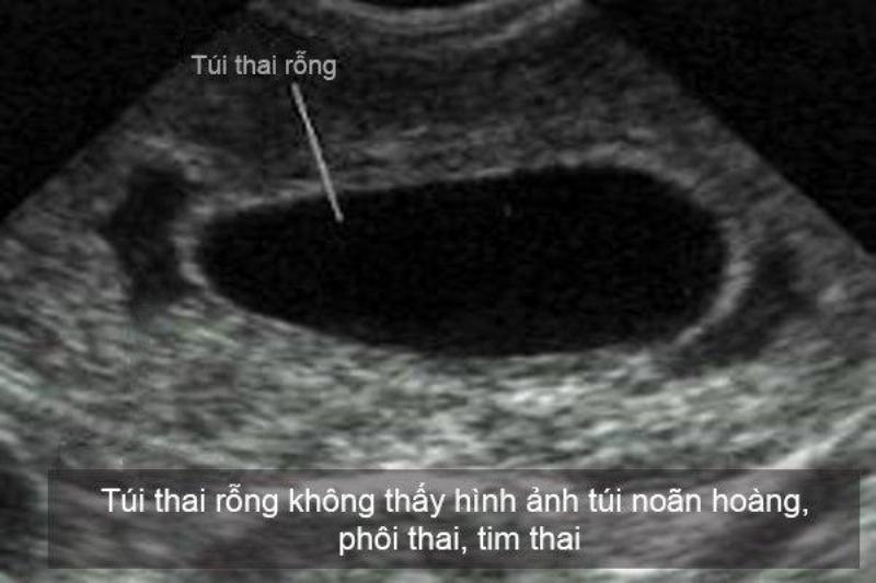 Hình ảnh siêu âm thai 5 tuần có thể thấy phôi thai và điểm tim thai sớm